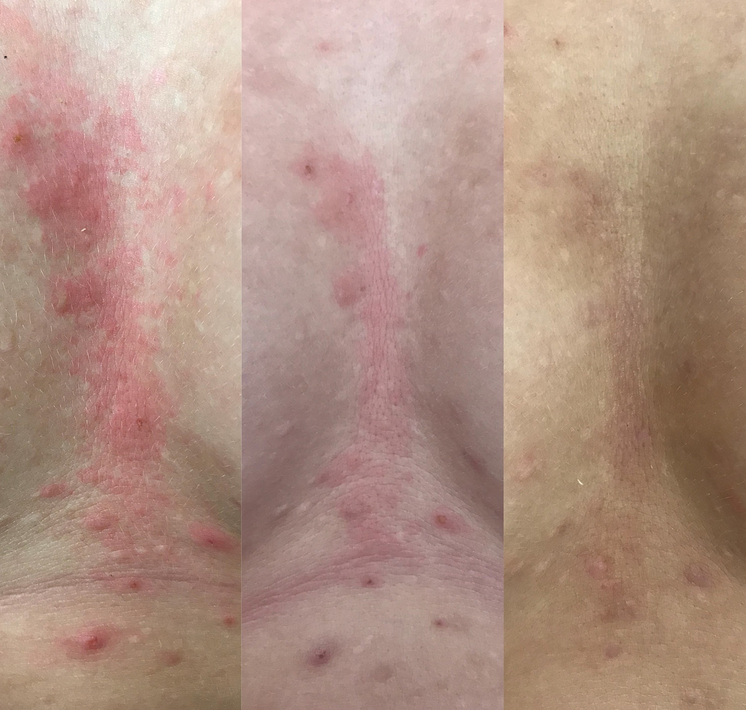 V létě se jakékoliv pleťové zákroky nedoporučují, nicméně akné, vyrážky apod. to ani v těchto měsících bohužel nevzdávají. Naše pacientky jsou ale důkazem, že pokud vás má na starost zkušený lékař, výsledky se dostaví již během 2 dnů a nemusíte svou pleť skrývat celé léto. Fotky jsou bez jakýchkoliv úprav. V létě se jakékoliv pleťové zákroky nedoporučují, nicméně akné, vyrážky apod. to ani v těchto měsících bohužel nevzdávají. Naše pacientky jsou ale důkazem, že pokud vás má na starost zkušený lékař, výsledky se dostaví již během 2 dnů a nemusíte svou pleť skrývat celé léto. Fotky jsou bez jakýchkoliv úprav.