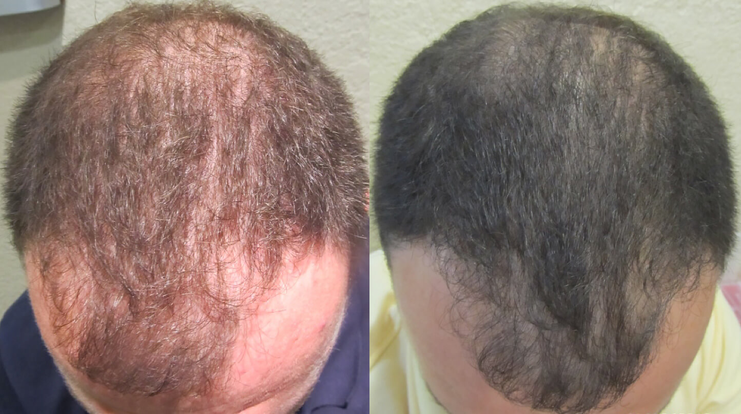 Example of hair loss treatment (before and after)