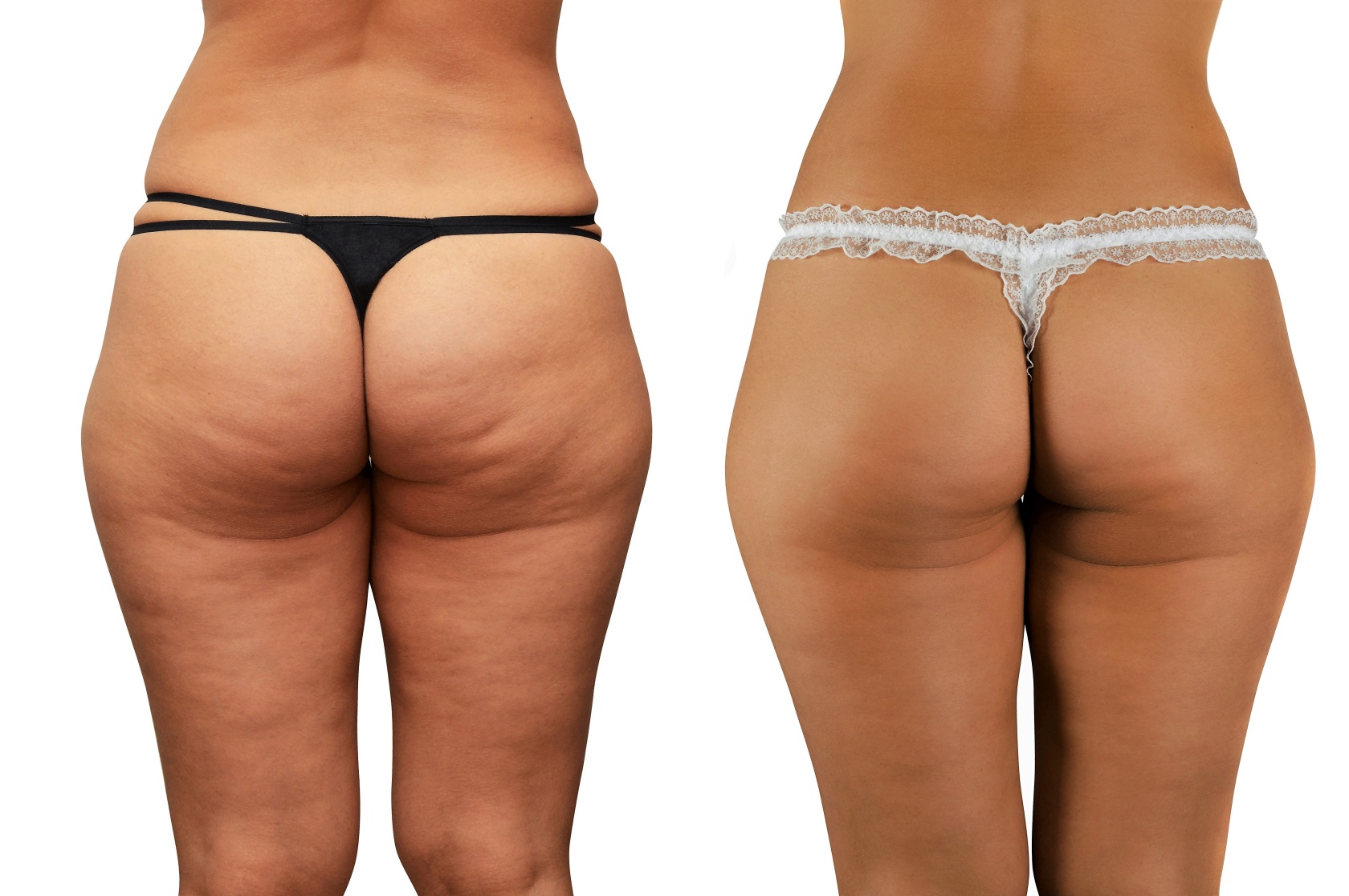 Example of cellulite treatment (before and after) Example of cellulite treatment (before and after)