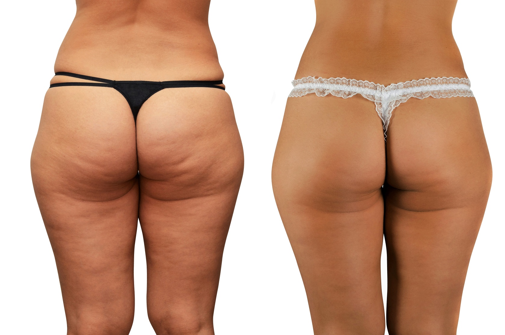 Entfernung von Cellulite