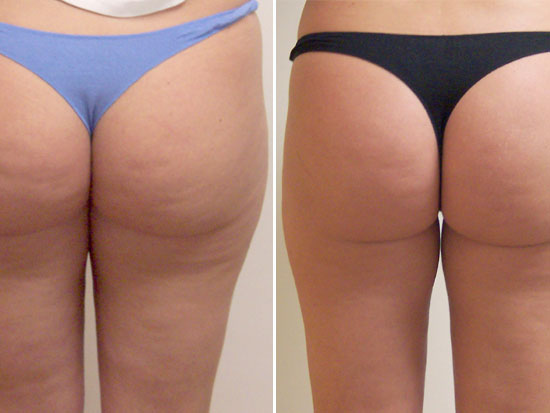 Example of cellulite treatment (before and after) Example of cellulite treatment (before and after)