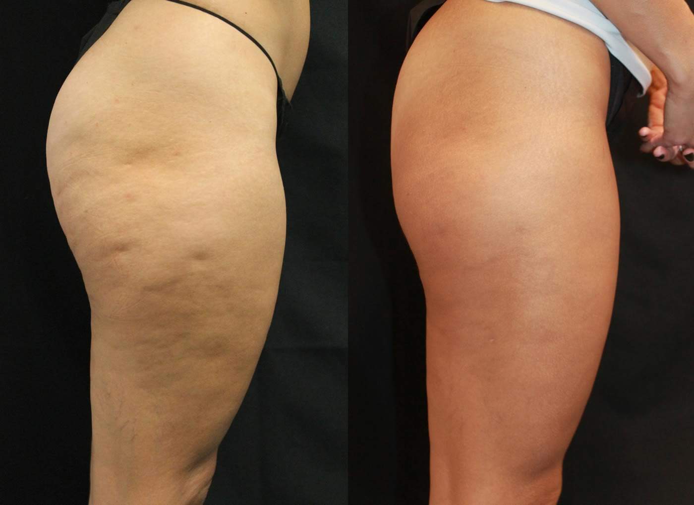 Example of cellulite treatment (before and after) Example of cellulite treatment (before and after)