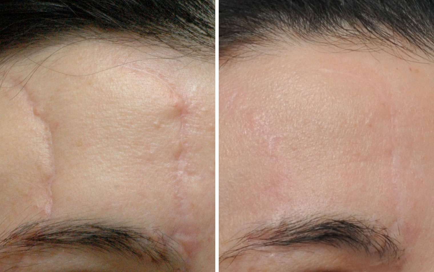 Example of scars and stretchmarks treatment (before and after)