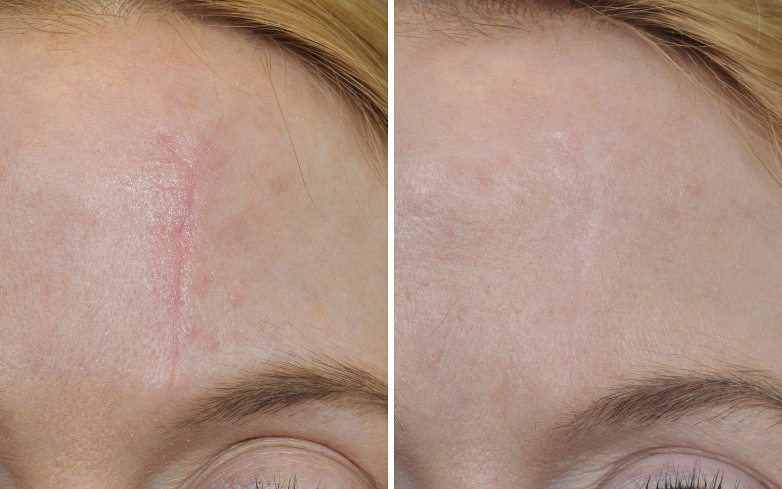 Example of scars and stretchmarks treatment (before and after)