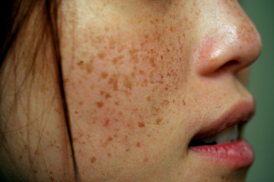 Treatment of pigmentation Treatment of pigmentation