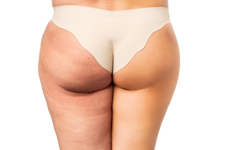 Entfernung von Cellulite