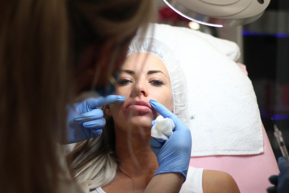 Filling with hyaluronic acid Filling with hyaluronic acid