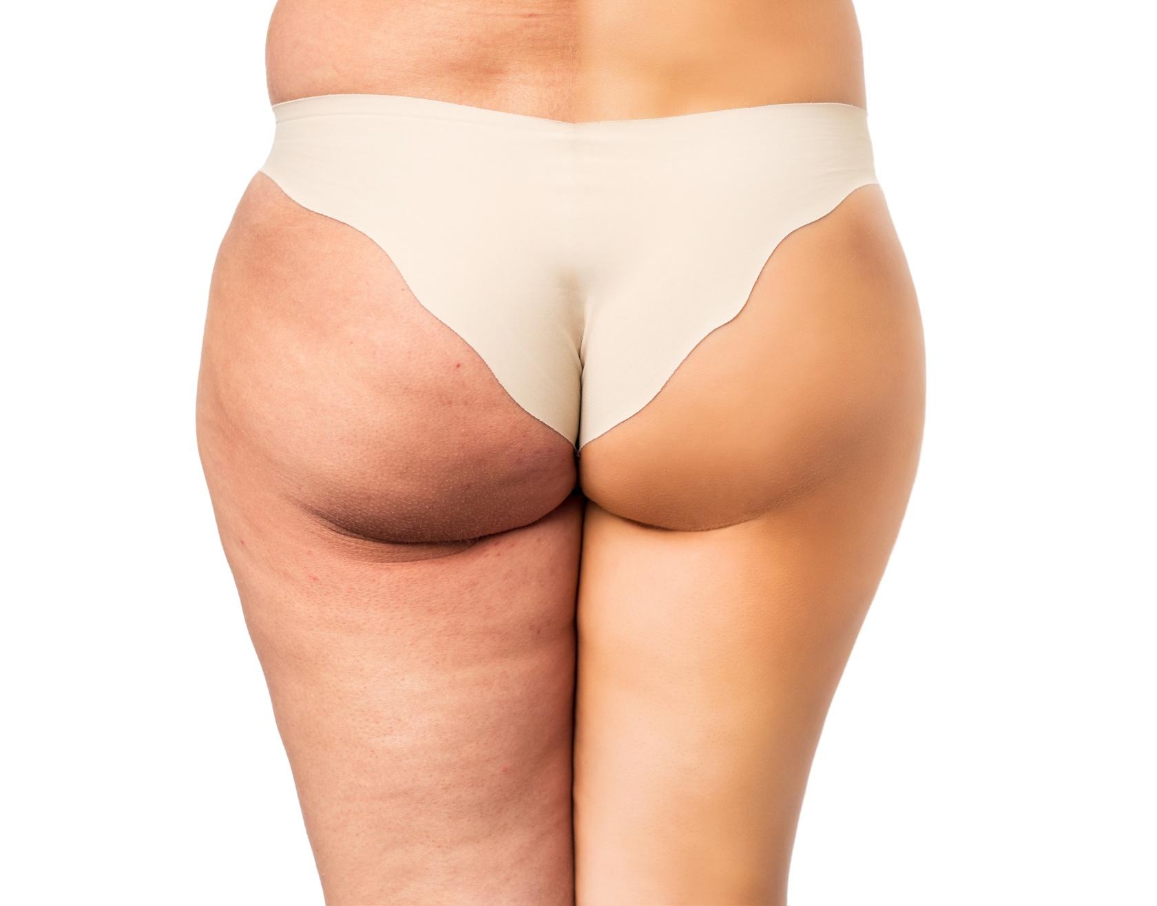  Cellulite treatment