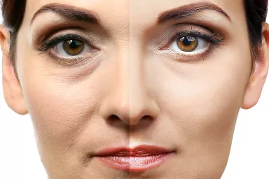 Wrinkles removal