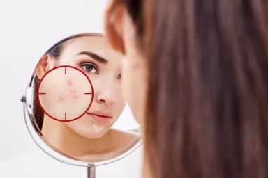 Acne treatment