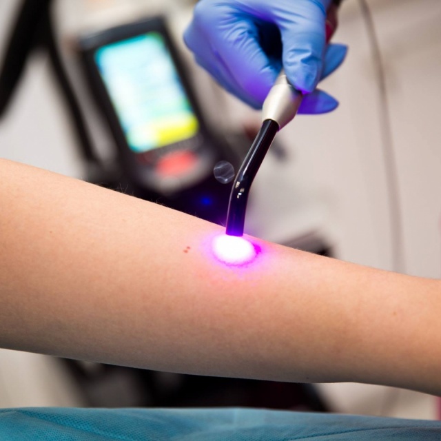 Laser treatments