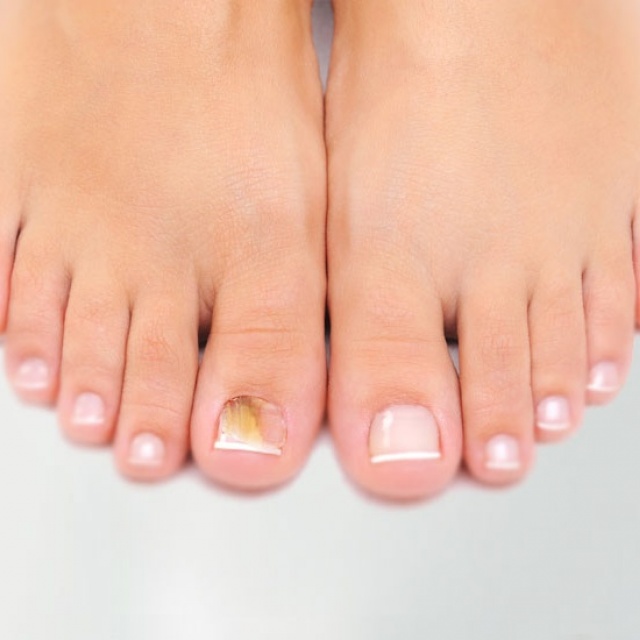 Nail fungus treatment