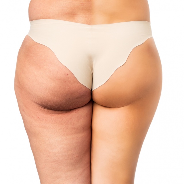 Entfernung von Cellulite