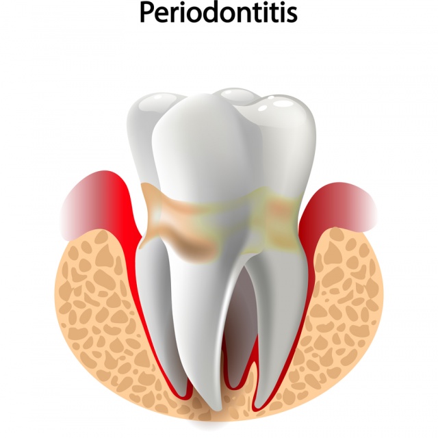 Léčba paradontózy