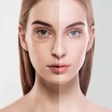 Removal of sunken eyes and undereye circles