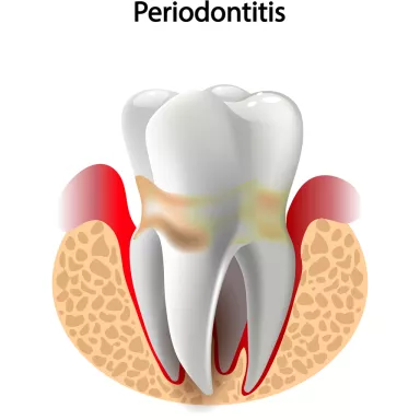 Periodontitis treatment