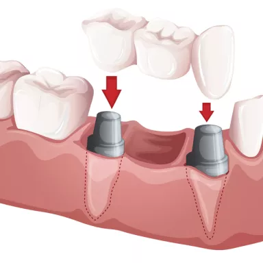 Dental prosthetics