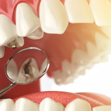 Dental caries treatment