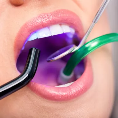 Dental fillings