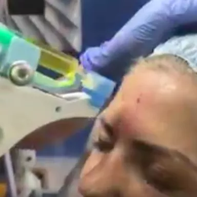 Autotransplantát krevní plazmy