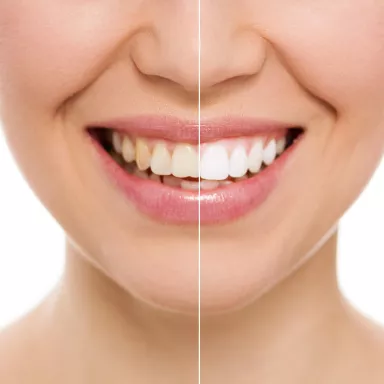 Teeth whitening