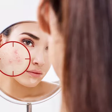 Acne treatment